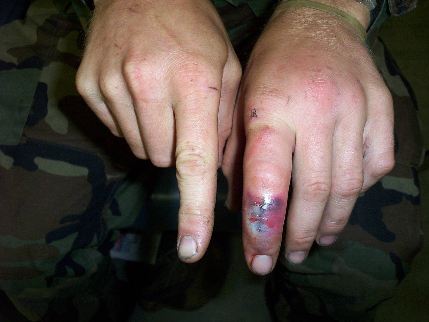 Cellulitis on the fingers