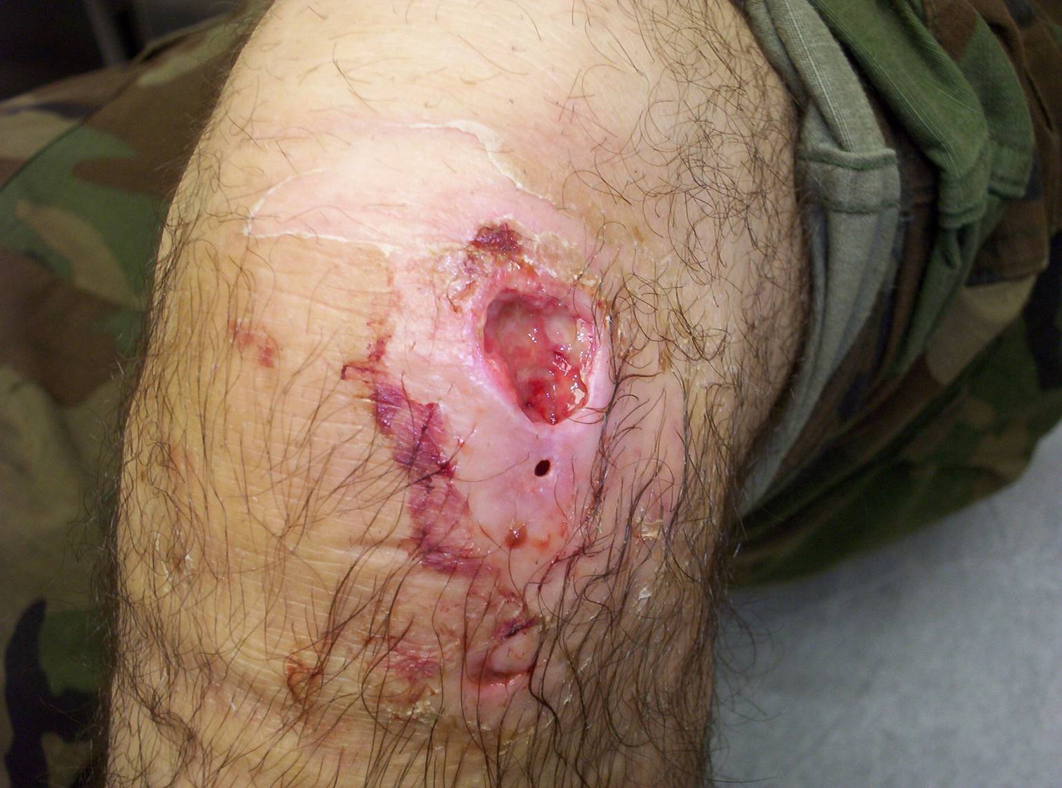 Cellulitis on the Knee
