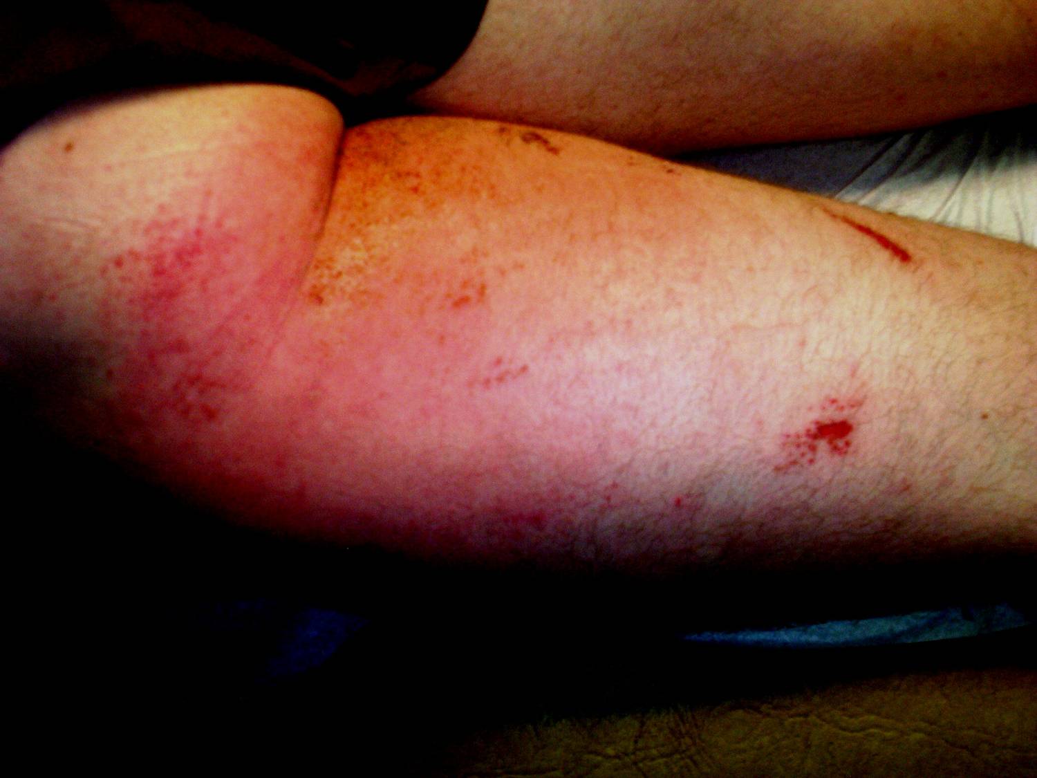 Cellulitis on the Thigh